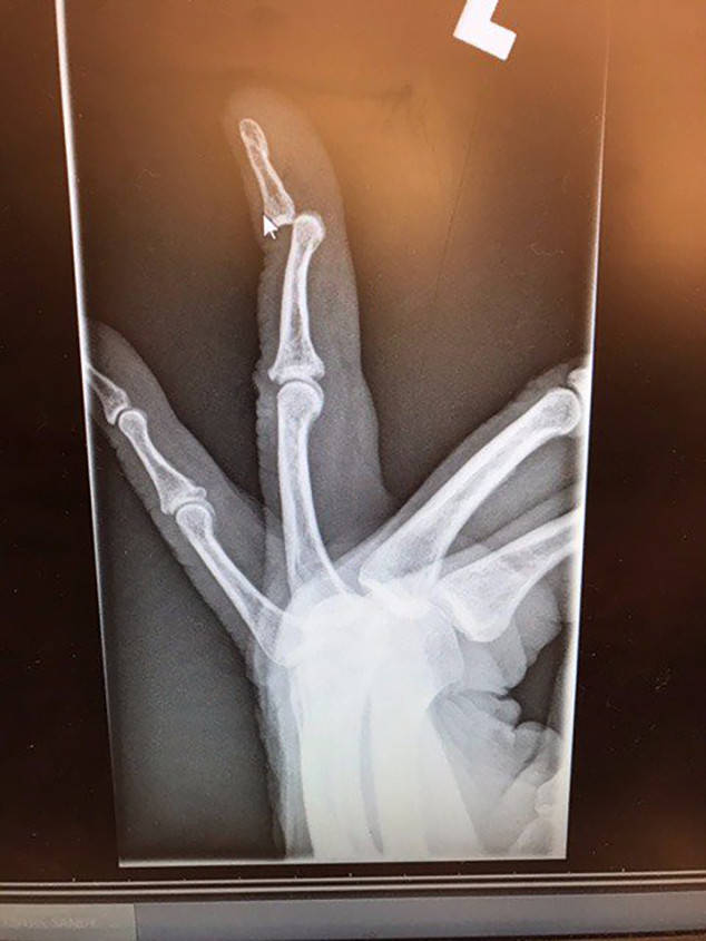 degeneres finger