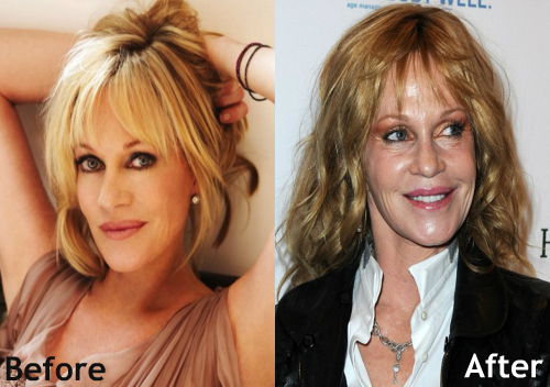 Melanie-Griffith-Plastic-Surgery